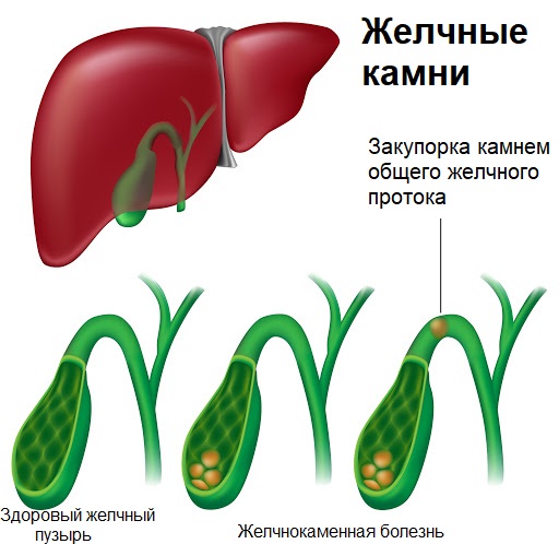 Стол 5 при желчнокаменной болезни и камнях в желчном